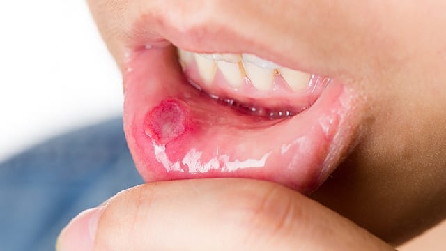 canker sore on cheek near wisdom tooth